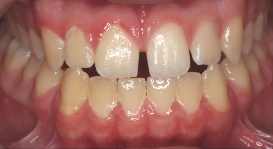 before orthodontics photo