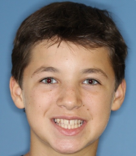 Aron before facial Patient Before