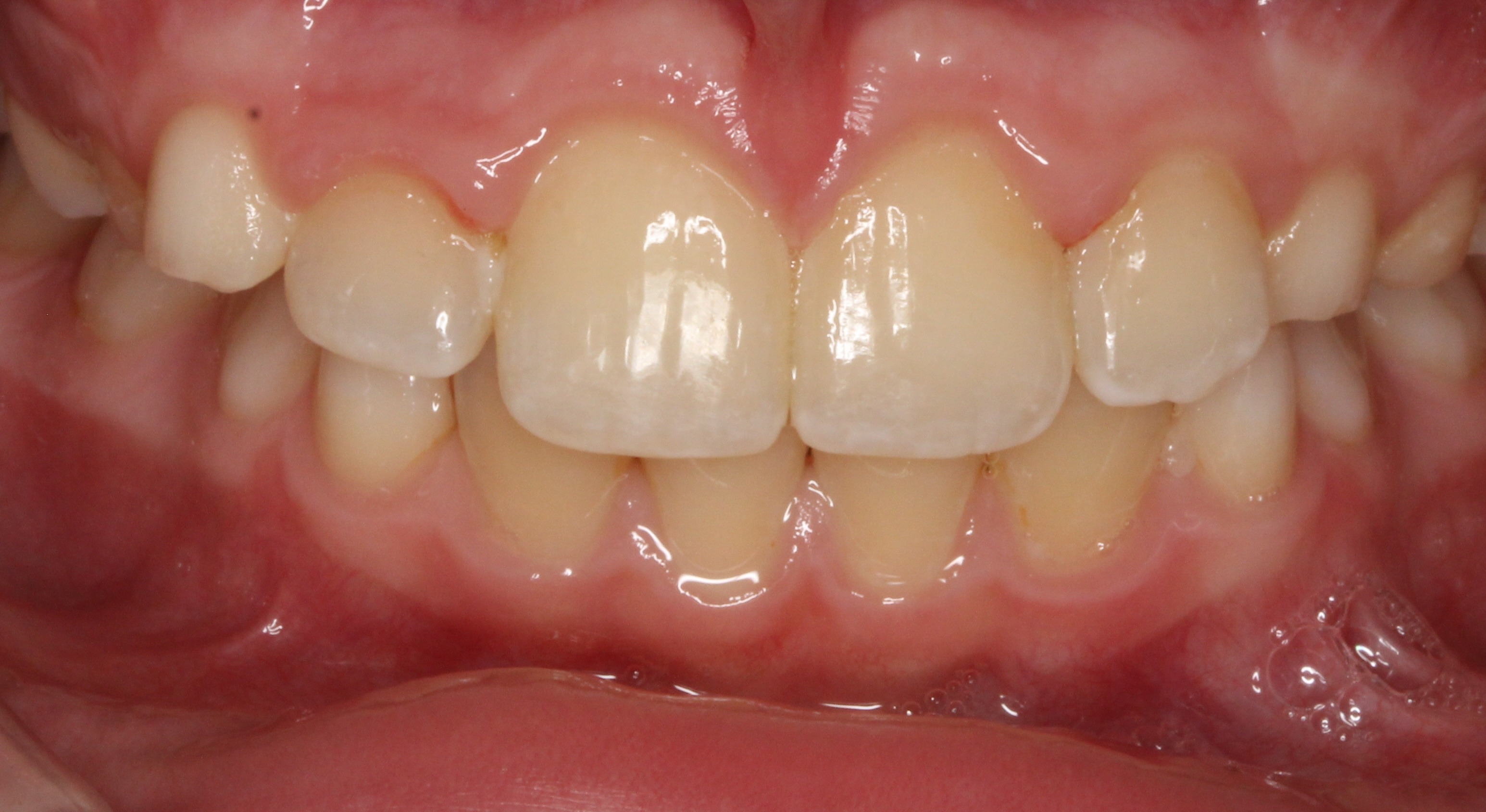 Biss After Teeth Patient After