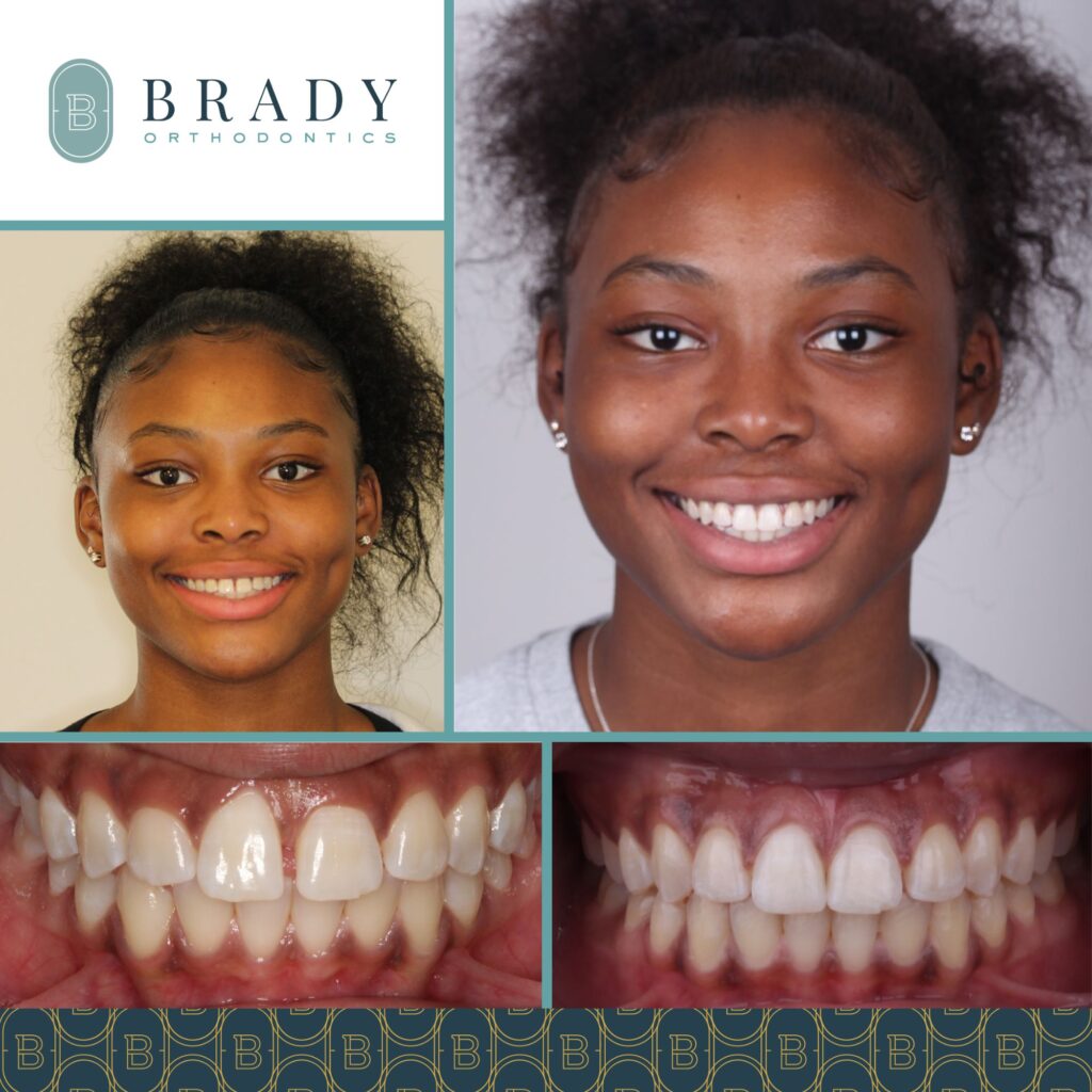 2022-02-07_Brady Ortho_Gingevectomy Before and After_TW-01