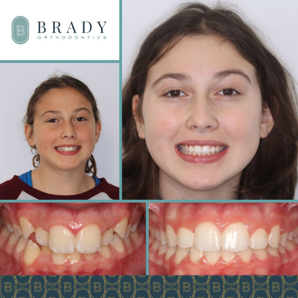 2022-03-09_Brady Ortho_Before and After Emily_CG-01