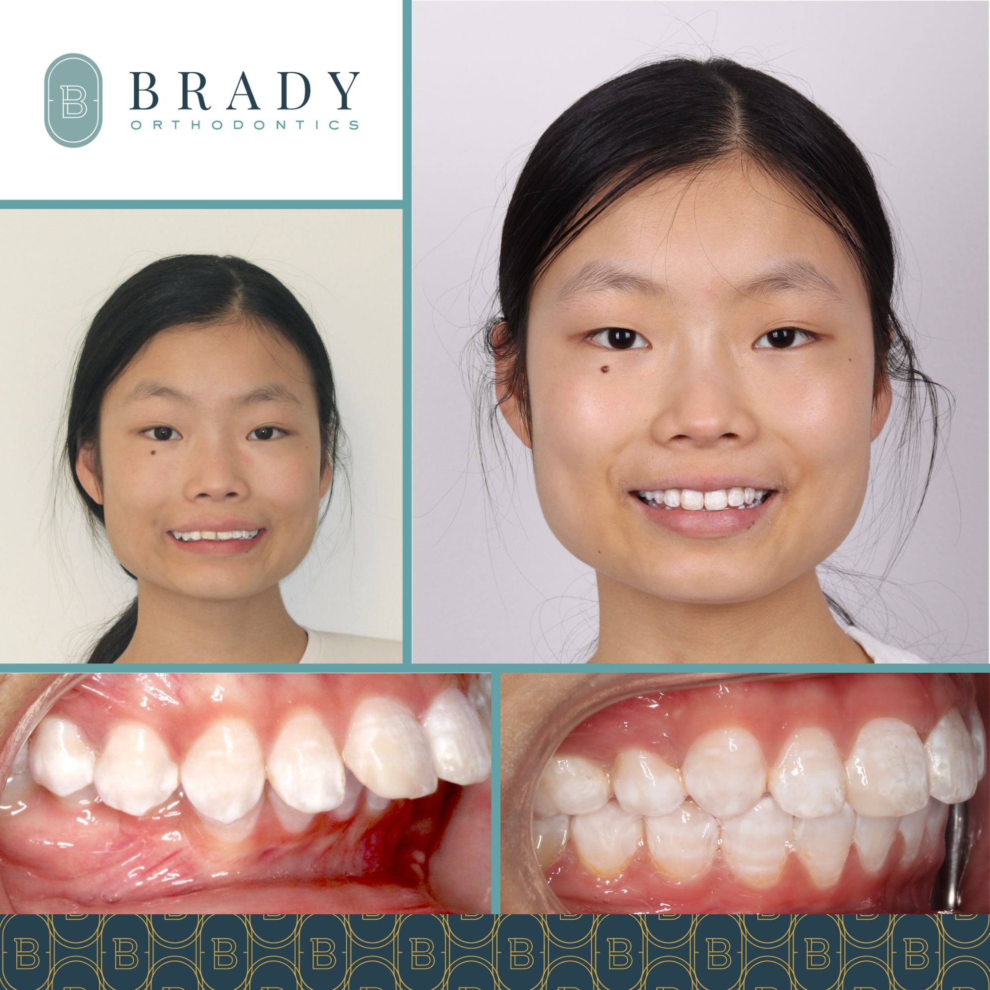 Orthodontic Before & Afters | Winnetka Orthodontist | Dr. Brady