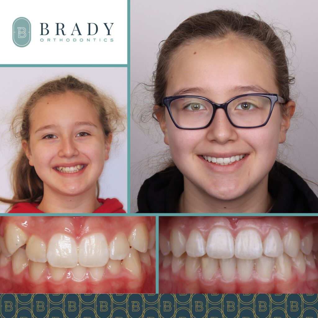 2022-05-05_Brady Ortho_Before and After Hailey_CG-01