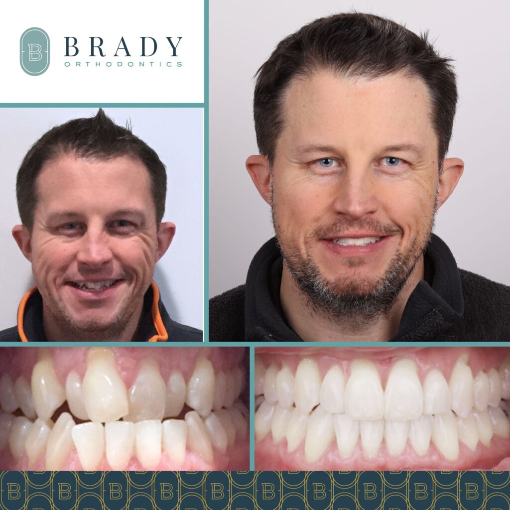 2022-05-24_Brady Ortho_Before and After Tim_CG-01