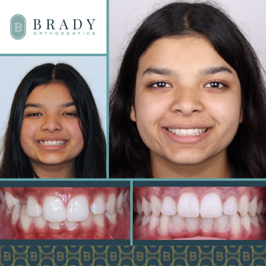 2022-06-23_Brady Ortho_Maisy Before and After_CG-01