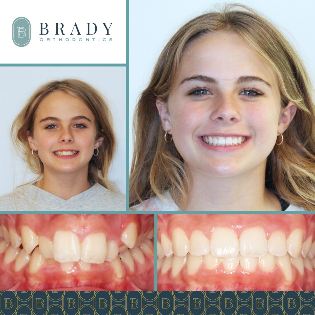 2022-06-29_Peyton Ortho_Maisy Before and After_CG-01