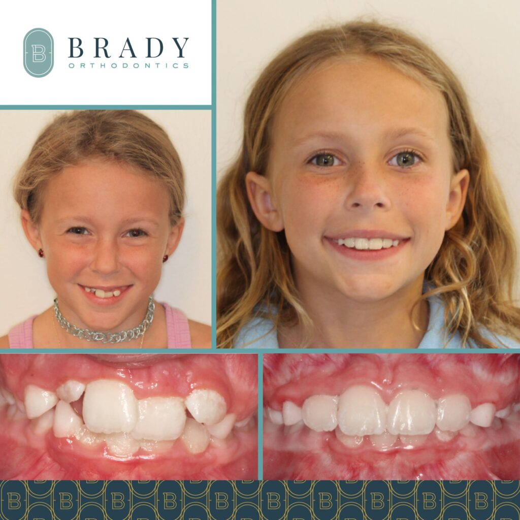 2022-08-10_Brady Ortho_Before and After Chelsea_TW-01