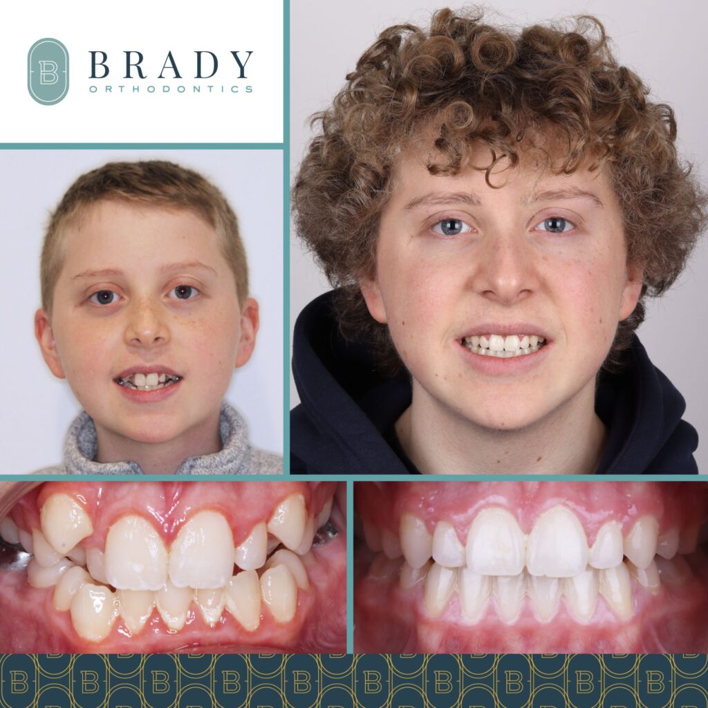 2022-12-02_Brady Ortho_Trey Before and After_CG-01