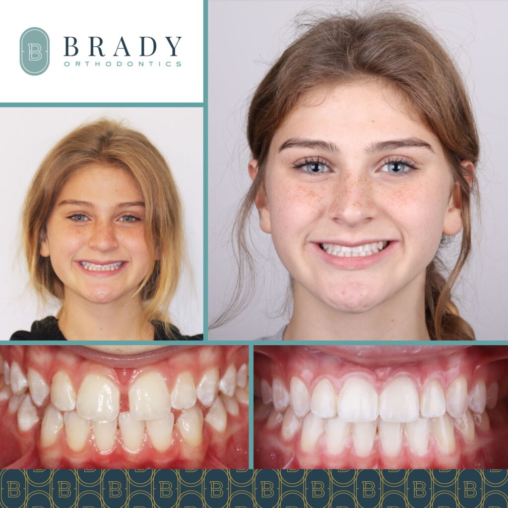 2023-01-26_Brady Ortho_Before and After_CG