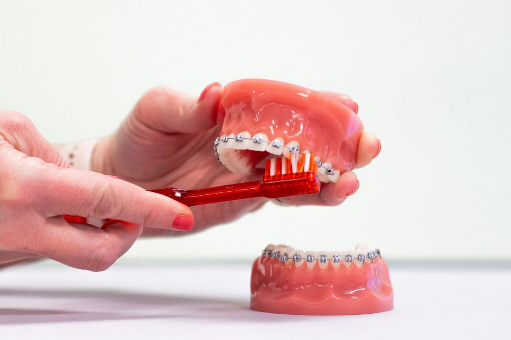 What Makes KLOwen Custom Braces Different? A Quick Answer