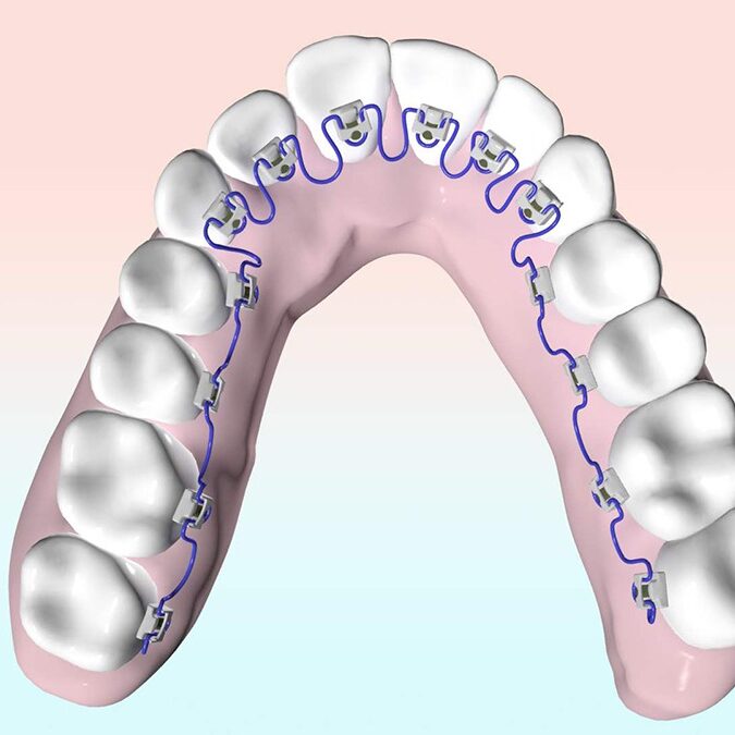 Lingual Braces